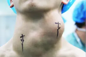 甲状腺癌的症状有哪些？视频封面