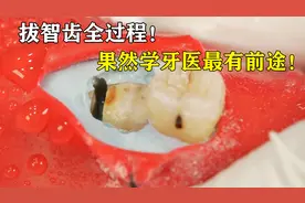 横着长的智齿，隐藏在牙龈之下，牙医直接将它分三半拔出，爽！视频封面