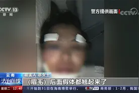 互勉打版？假体都翘起来了 发朋友圈免费做医美 多人背巨额美丽贷视频封面
