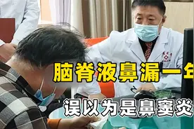 男子脑脊液从鼻子里流出来，却被误诊为鼻窦炎治疗一年多视频封面