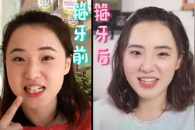 成年后箍牙晚吗？要花多少钱？分享这几年的正畸经验（干货篇）视频封面