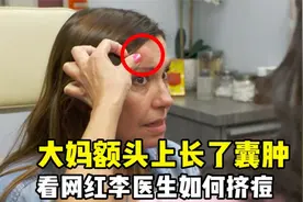 大妈额头上长了个囊肿，看网红李医生如何挤痘痘，实在是太解压了