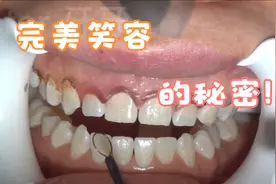 牙医揭秘完美笑容的秘诀，轻松get治愈系初恋笑容，拒绝露龈笑