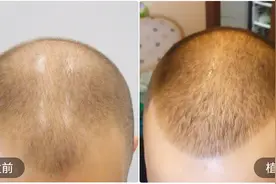 小伙天生头发就少，脱发后脑门油光锃亮，没想到植发后竟成功逆袭视频封面
