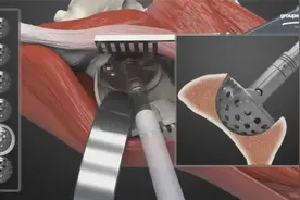 3D动画展示股骨头置换手术，隔着屏幕都感觉到腿麻了视频封面