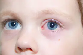 眼睛发红就是红眼病？显然不是，这些原因是关键视频封面