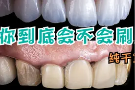 疯涨牙结石的原因是没认真刷牙，就我这方法刷牙就能刷掉牙结石视频封面