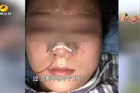 女子花18000元做隆鼻  称肋骨要顶破鼻尖了视频封面
