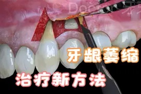 医学3d动画：牙龈退缩不可怕，介绍4套新治疗方法，分析退缩原因视频封面