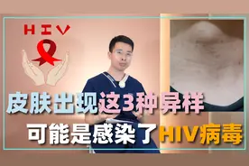皮肤出现这3种异样，不仅仅是皮肤病，或是感染了HIV病毒
