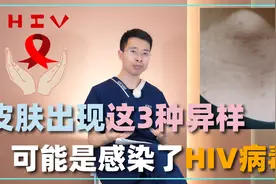 皮肤出现这3种异样，不仅仅是皮肤病，或是感染了HIV病毒视频封面