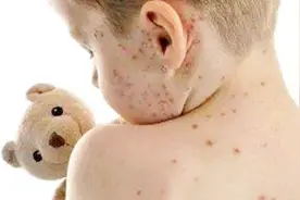什么是玫瑰糠疹？会传染吗？视频封面