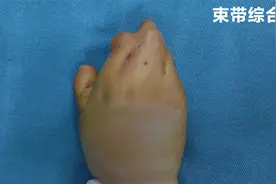 1岁多女孩右手4根手指粘连在一起，骨头很乱，不让别人碰手视频封面