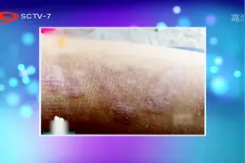 小伙被跳蚤叮咬引发皮肤病，使用民间偏方竟变成白癜风，太离奇了