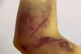 女生抽血后手臂淤青发黑：后来还晕倒了，手臂都伸不直，院方回应视频封面