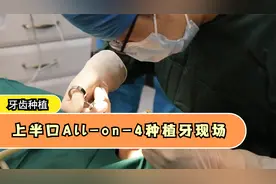 种植牙现场：全口牙缺失想种牙又害怕！先做上半口All-on-4视频封面