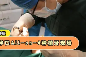 种植牙现场：全口牙缺失想种牙又害怕！先做上半口All-on-4视频封面