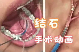 下巴老是肿，原来是有结石，看完手术动画，立马治疗免去切除之苦视频封面