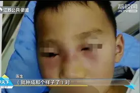 5岁男孩挖鼻孔致发炎，脸肿成“奥特曼”！这个危险三角区碰不得视频封面