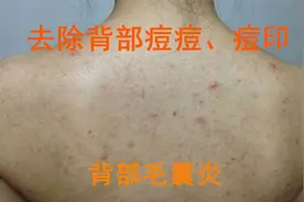 背上痘痘几年没见好，解决起来两步到位！背部排浊！背部毛囊炎！视频封面