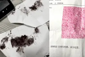 女子擦鼻涕带血，以为只是上火去医院一查被吓坏：没想到这么严重视频封面