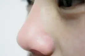 口臭是不仅因为肠胃不好引起的，还可能是鼻子惹的祸视频封面