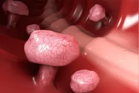 什么是子宫息肉？医生坦言：是宫颈炎的表现，必要时需手术摘除视频封面
