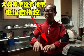 大叔得了一种怪病，十只手指没有指甲和指纹，连喝水杯都拿不稳！视频封面