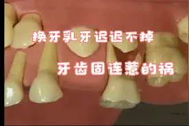 换牙乳牙齿迟迟无法掉落的原因，原来是牙齿固连惹的祸视频封面