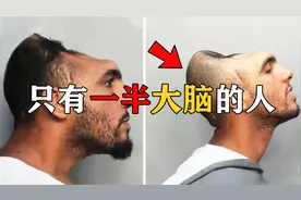 人失去一半大脑还能活吗？实际情况可能颠覆你的想象！