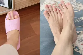 44岁女子晒奇特脚趾，怕吓人不穿凉鞋丝袜1天1换：脚印够专家研究视频封面