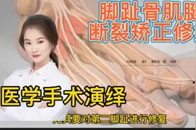 医学手术演绎  脚趾骨肌腱修复和跖骨矫正手术 看完你明白视频封面