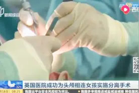 英国医院为头颅相连女孩实施分离手术，最后宣布成功视频封面