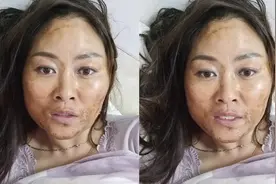 女子称阳了后上吐下泻，4天瘦8斤脸上让她感慨：亲妈都快不认识我视频封面