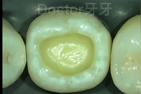 牙齿蛀空了，分享一看就会的补牙方法，是不是很简单你学会了吗？视频封面