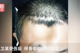 奇迹！41岁男子因车祸致头顶出现大坑 3D打印帮他恢复原貌视频封面