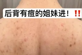 5秒搓走螨虫！顽固痘痘一招就根除！粗糙后背秒变光滑水嫩！视频封面