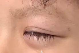 广东一7岁男童被铅笔戳伤眼睛！医生提醒：别揉，可能有毒视频封面