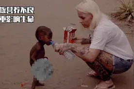 一些非洲儿童因为没有饭吃导致营养不良，严重影响生命安全