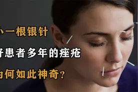 小小一根银针，治好患者多年的痤疮，它为何如此神奇？视频封面