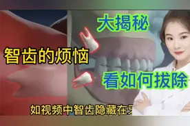 医学演绎 人体智齿疼痛 影响周边牙齿发炎臃肿 医生如何处理视频封面
