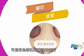 拔罐后的颜色能反应病情，专家讲解颜色代表的病症，快来看一下吧视频封面