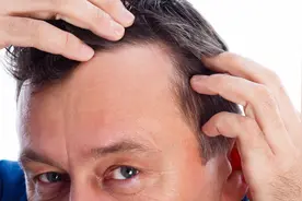 额头两边掉头发，M型脱发如何拯救？看这里，医生有办法