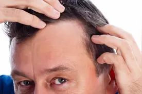 额头两边掉头发，M型脱发如何拯救？看这里，医生有办法