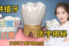 医学演绎人体种植牙全套过程是怎么样的 医生如何一步步完成种牙视频封面