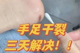 手足干裂多半是这几个原因！3个妙招轻松应对，精准解决不反复！视频封面
