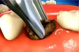 拔蛀牙到底是怎样的过程？3D动画模拟全程，看完不禁直冒冷汗