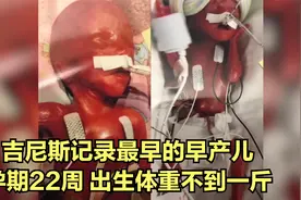 吉尼斯记录最早的早产儿，孕期22周出生不到一斤，双胎输血综合症视频封面