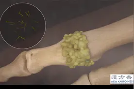 看过了才知道，痛风原来是这样发作的！视频封面