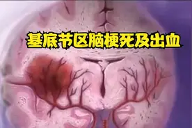 基底节区脑梗死及出血，人体最常见的脑梗死及出血部位